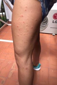 bites on leg