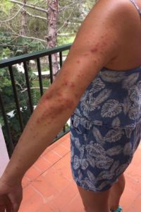 bites on arm