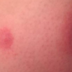 bed bug welts