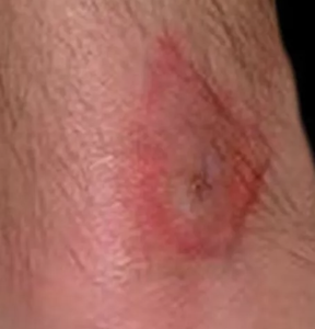 horsefly bite on skin
